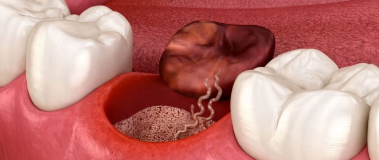 Severe Pain and Bad Smell 2–4 Days After Tooth Extraction?