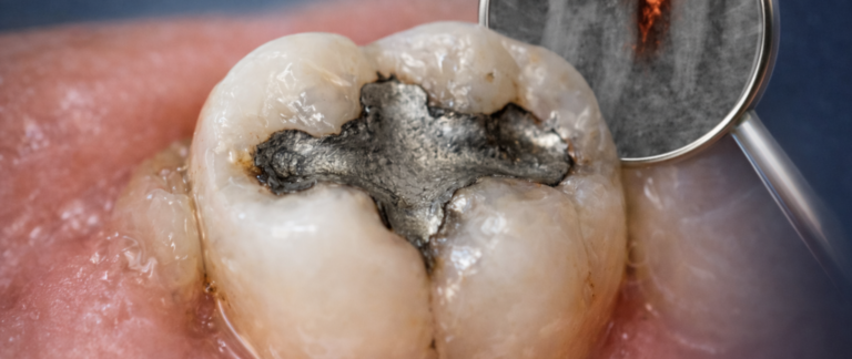 Pain or Sensitivity in a Tooth with an Old Filling?