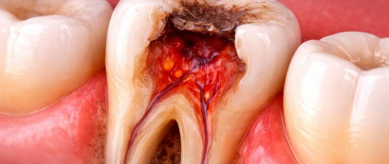 Does Pain Linger After Cold or Hot Food?