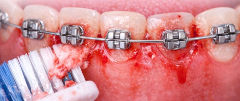 Swollen Gums or Bleeding While Brushing with Braces?