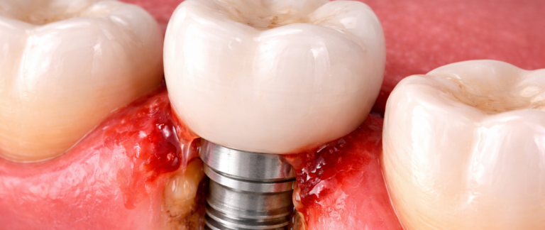 What is Peri-implantitis (Implant Infection)?