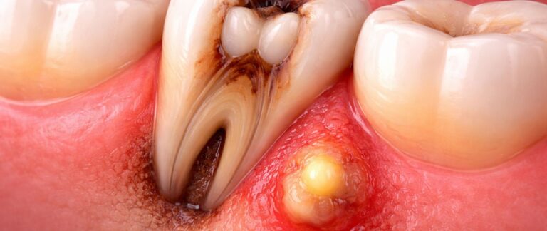 Severe Throbbing Pain with Swelling?