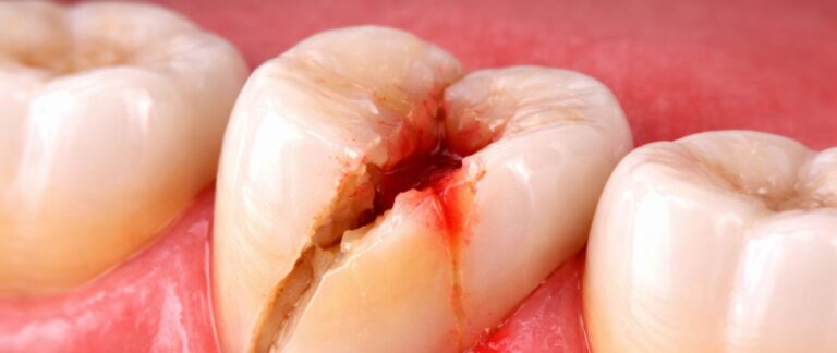 Has a Large Part of Your Tooth Broken?