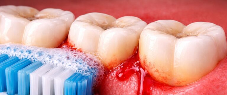 Do Your Gums Bleed While Brushing?