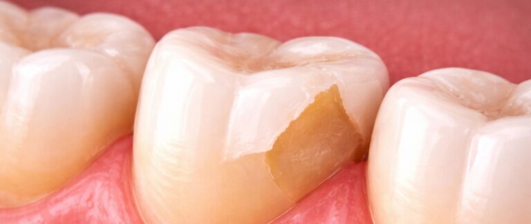 Is Your Tooth Corner Broken or Feeling Sharp?