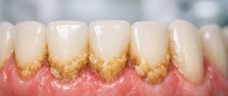 What is Tartar (Calculus)?