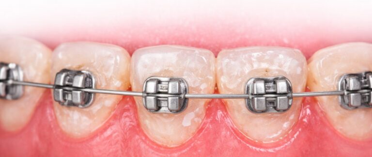 White Chalky Spots Around Braces?