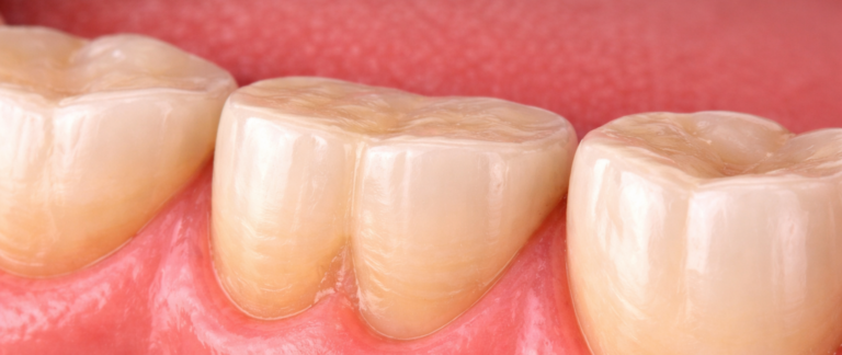 What is Tooth Wear?