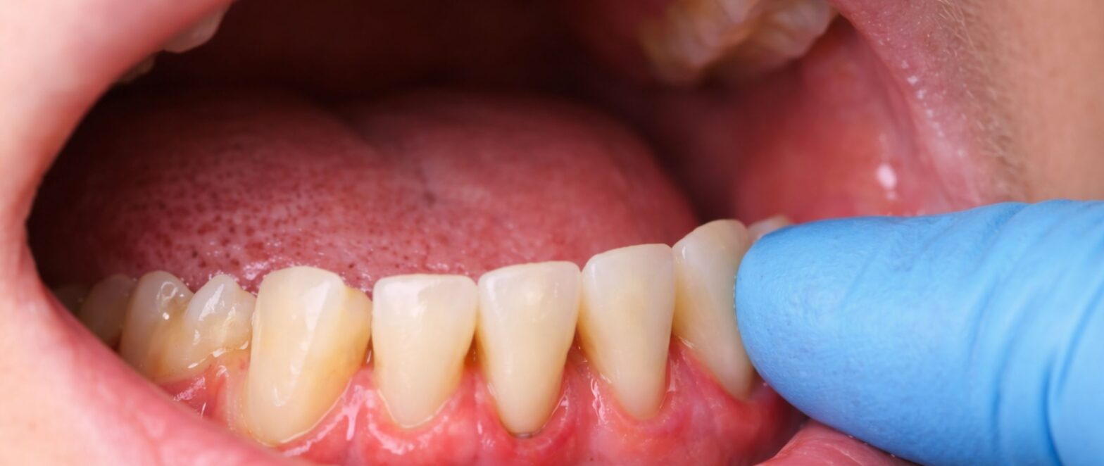 Close-up of slightly loose teeth showing early signs of gum disease and bone loss, highlighting the need for timely dental treatment.