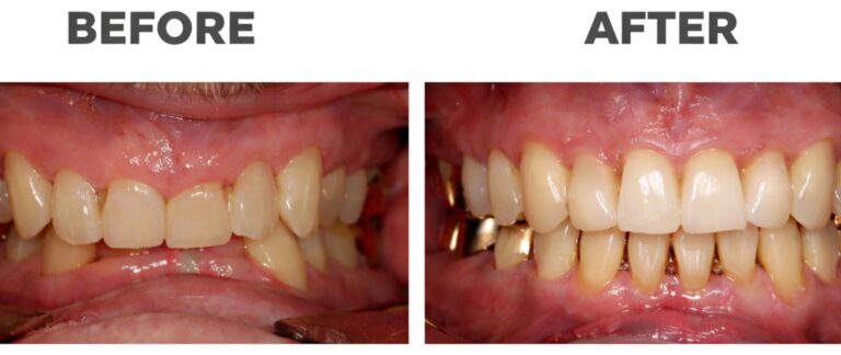 What is Gum Recession?