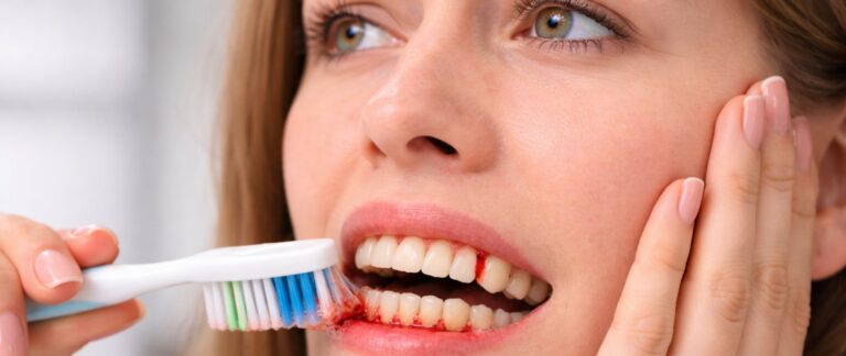What are Bleeding Gums (Gingivitis)?