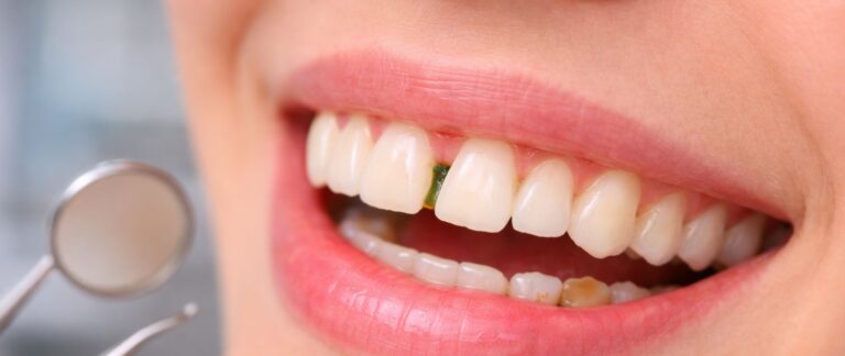 What is Teeth Gap (Diastema)?