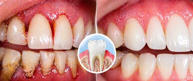 Bleeding Gums or Loose Teeth? Don’t Delay Gum Treatment
