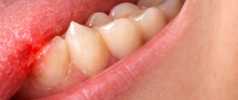 What is a Sharp Tooth Edge?
