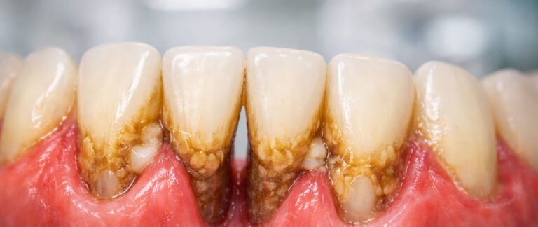 What is Periodontitis (Pyorrhea)?