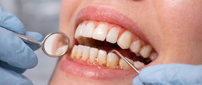 What is a Loose Tooth in Adults?
