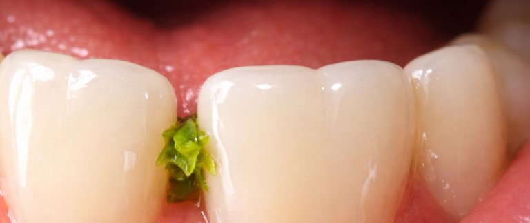 Why Does Food Get Stuck Between Teeth After Every Meal?