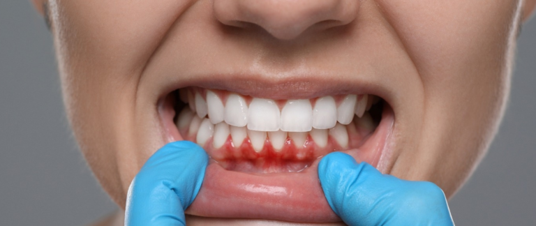 Can Gum Disease Affect Heart Health?