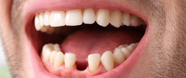 Can Teeth Shift in Adults Over Time?