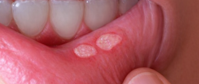 Do You Get Mouth Ulcers Again and Again?