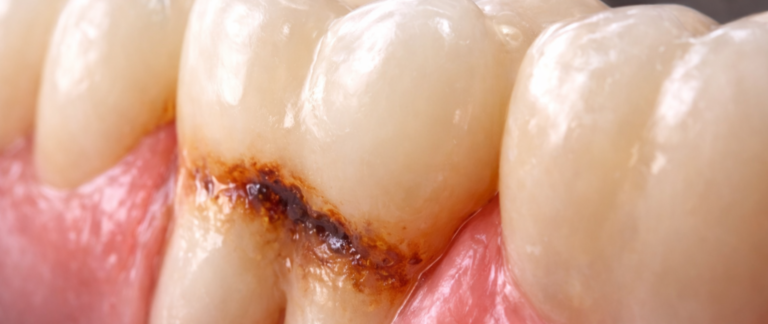 Are Your Gums Receding?