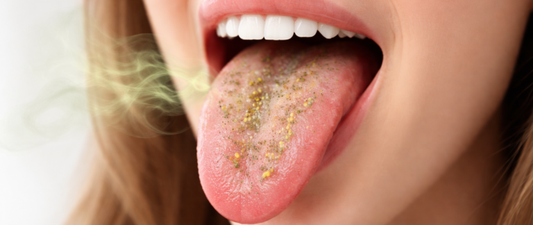 Why Does Bad Breath Persist Even After Brushing?
