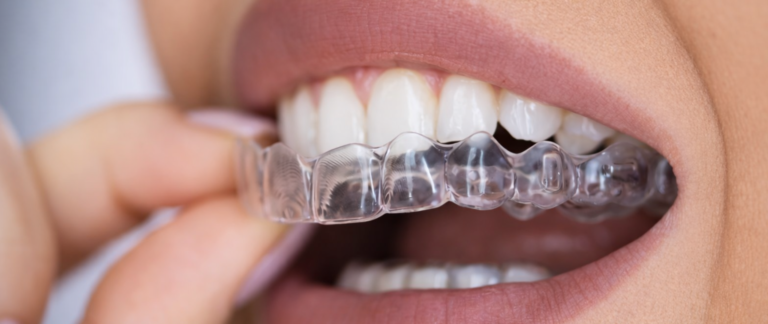 Looking for Clear Aligners for a Perfect Smile?