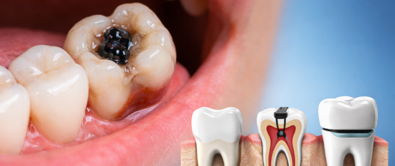 Black Spot on Tooth or Pain with Cold & Sweet?