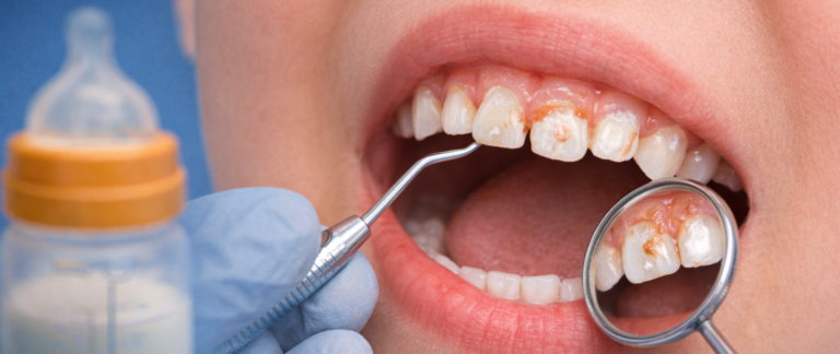 Are Your Child’s Milk Teeth Getting Damaged Early?