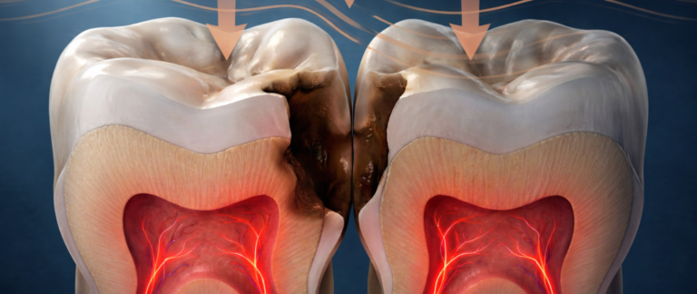 Pain While Flossing or Food Getting Stuck Between Teeth?