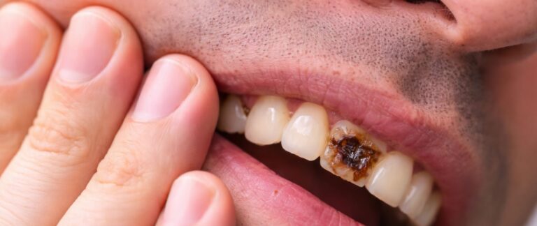 Tooth Decay & Pain – Is It Just Sensitivity or Something More?