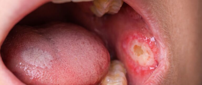Is a Mouth Ulcer Not Healing? Could It Be an Early Sign of Oral Cancer?
